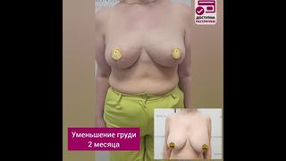 Уменьшение груди